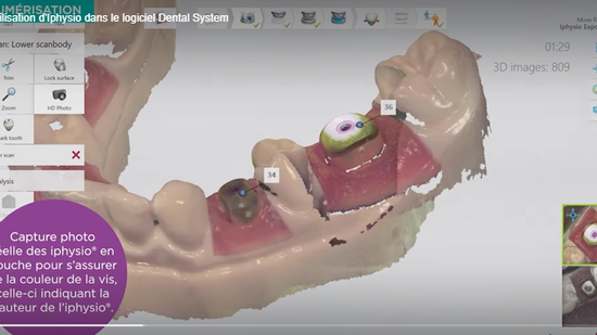 Utilisation d’Iphysio dans le logiciel Dental System